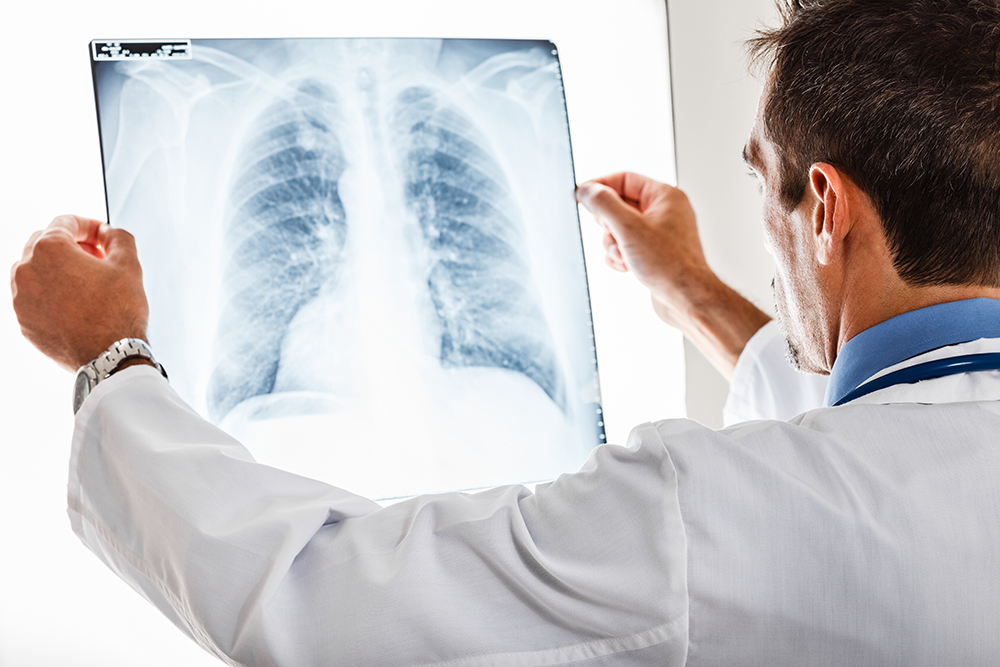 폐암 4기 생존율 사진들고 있는 의사